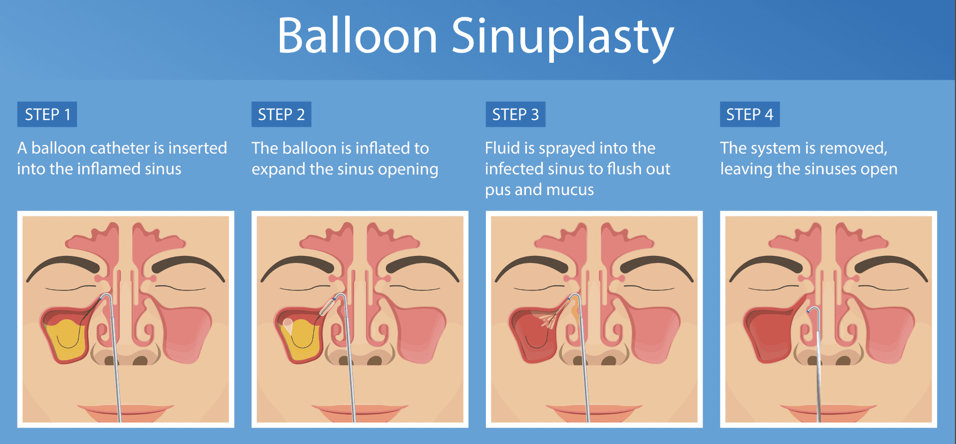 What Is Balloon Sinuplasty AESC